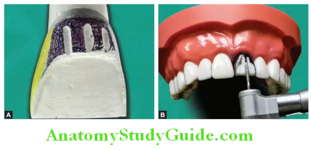 Tooth Preparation To Receive All Ceramic Crown removal of tooth structure between the grooves