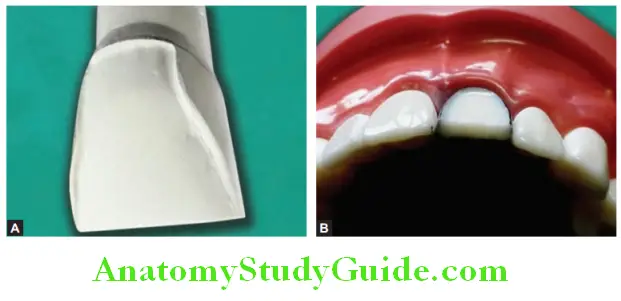 Tooth Preparation To Receive All Ceramic Crown shoulder finish line on labial surface