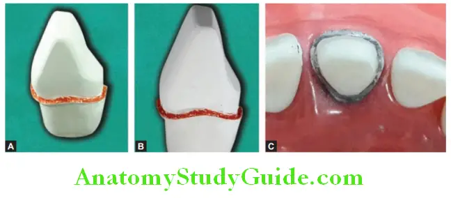 Tooth Preparation To Receive All Ceramic Crown tooth preparation and shoulder finish line side view and top view
