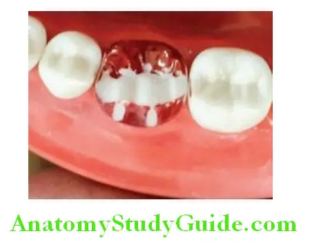 Tooth Preparation To Receive All Metal Crown depth cuts ontriangular ridges