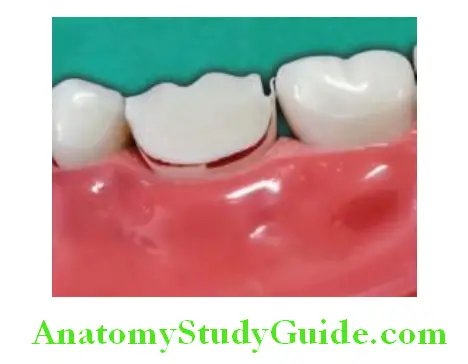 Tooth Preparation To Receive All Metal Crown enamel lip preparation