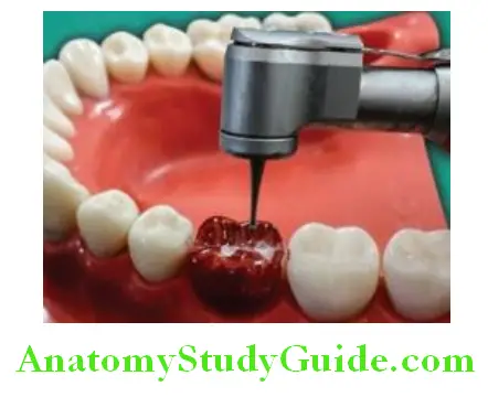 Tooth Preparation To Receive All Metal Crown placing depth cuts
