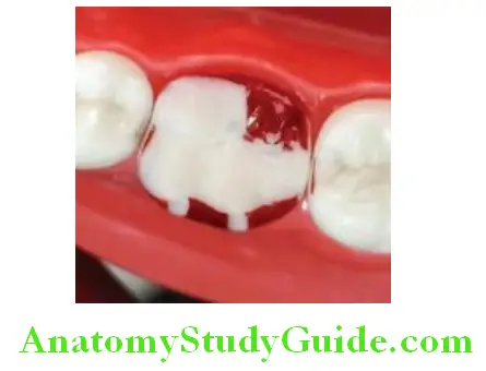 Tooth Preparation To Receive All Metal Crown remove tooth between the grooves