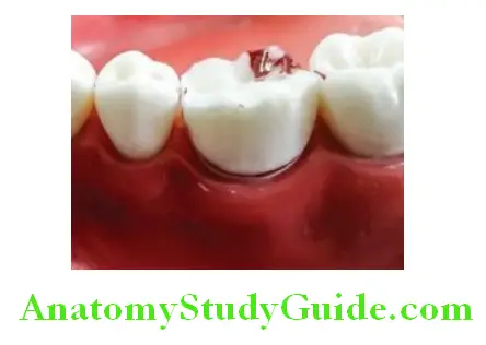 Tooth Preparation To Receive All Metal Crown remove tooth stucture between grooves on buccal surface