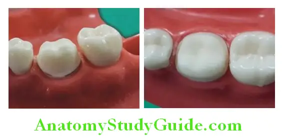 Tooth Preparation To Receive All Metal Crown tooth prepared to recive all metal full veneer crowns side view and top view