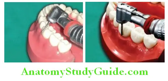 Tooth Preparation To Receive All Metal Crown two planes on buccal surface of mandibular molar