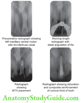 Vital Pulp Therapy Management Of Left Maxillary Central Incisor By Calcium Hydroxide Apexification