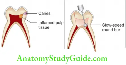 Vital Pulp Therapy Schematic Representation Of Formocresol Pulpotomy