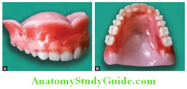 Wax Up Of Complete Denture add wax on labial buccal and palatal surfaces of trial denture