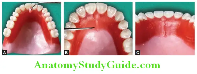 Wax Up Of Complete Denture addition and contouring of wax to make incisie papillae and midpalatine raphe