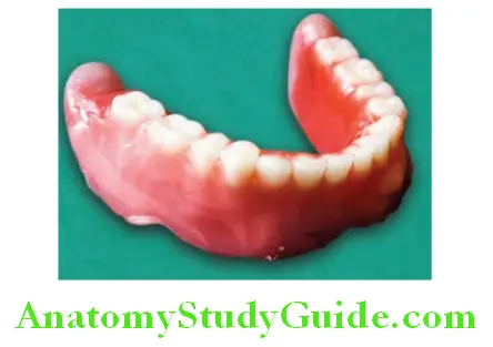 Wax Up Of Complete Denture addition of wax on labial buccal and lingual surface