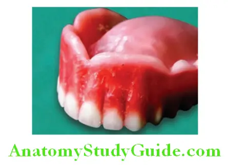 Wax Up Of Complete Denture apical end of carving is slightly distally tilted