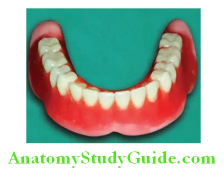 Wax Up Of Complete Denture buccal flange inclines and inferiorly