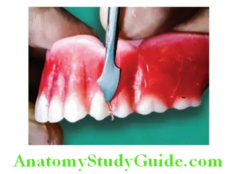 Wax Up Of Complete Denture carving the gingival margin for posterior teeth
