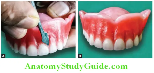 Wax Up Of Complete Denture carving the gingival margin of anterior teeth