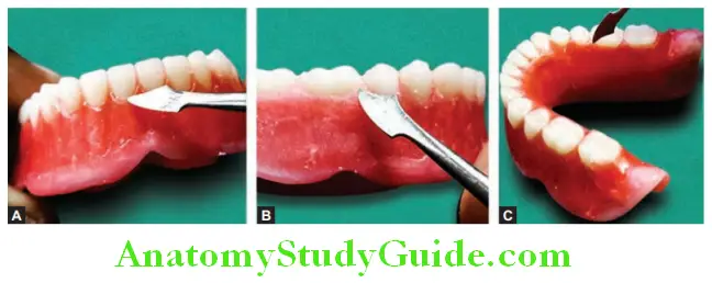 Wax Up Of Complete Denture carving the gingival margins for anterior teeth