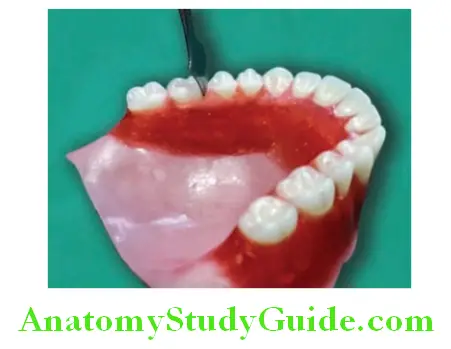Wax Up Of Complete Denture carving the gingival margins on palatal side