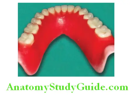 Wax Up Of Complete Denture distobuccal area of lingual flange meged with retromylohyoid area