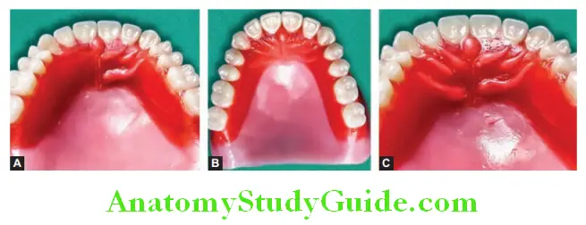 Wax Up Of Complete Denture making rugae on anterior palate