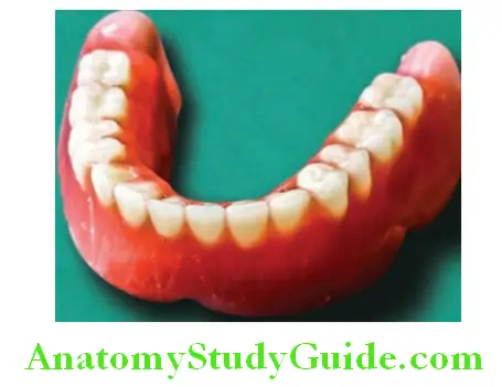 Wax Up Of Complete Denture marking the roots on mandibular trial denture