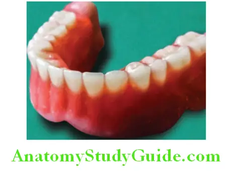 Wax Up Of Complete Denture shaping the roots on trial denture