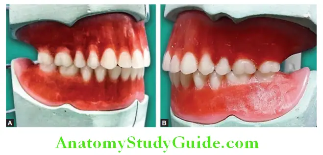 Wax Up Of Complete Denture waxed up maxillary and mandibular dentures