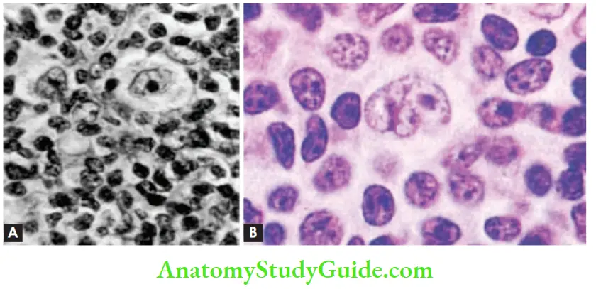 White Blood Cells Disorder and Lymph Nodes (A) Lacunar cell; (B) Popcorn cell