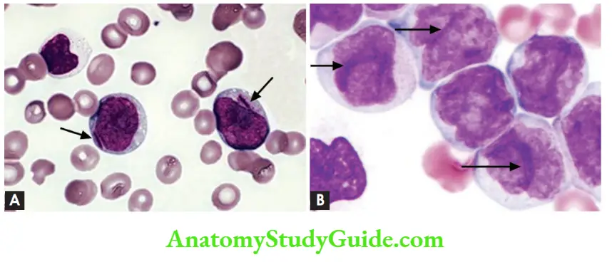 White Blood Cells Disorder and Lymph Nodes (A) Myeloblasts with Auer rods; (B) Monoblasts