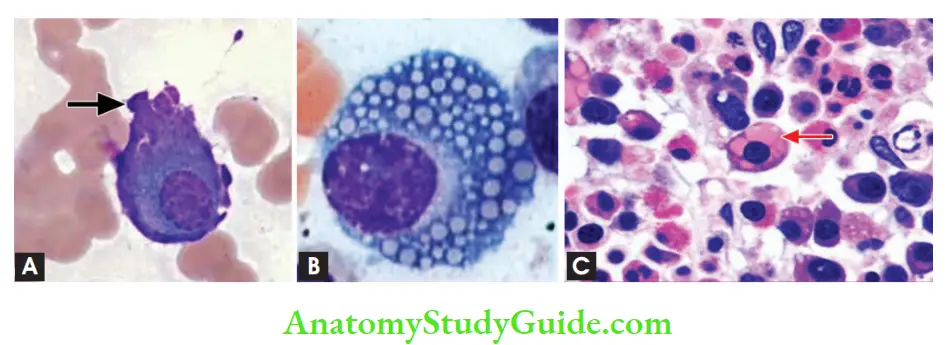 White Blood Cells Disorder and Lymph Nodes Cells and inclusions in multiple myeloma (A) Flame cell; (B) Mott cell; (C) Russell body