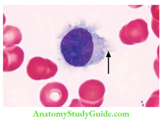 White Blood Cells Disorder and Lymph Nodes Hairy cell in a peripheral smear
