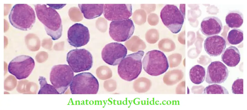 White Blood Cells Disorder and Lymph Nodes Lymphoblasts in acute lymphoblastic leukemia