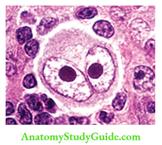 White Blood Cells Disorder and Lymph Nodes Reed-Sternberg cell with bi-lobed nucleus (owl’s eye appearance)