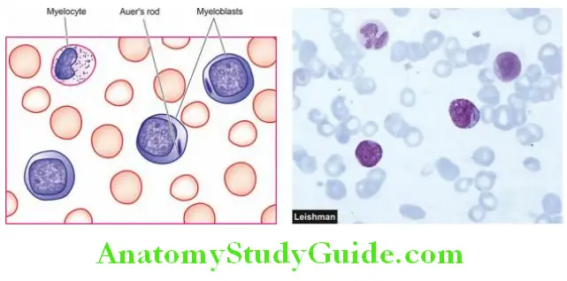 White Blood Cells Proliferations and Myeloid Neoplasms peripheral blood finding in a case of acute myeloblastic leukaemia