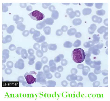 White Blood Cells Proliferations and Myeloid Neoplasms peripheral blood flim showing lymphocytes in infectious mononucleosis