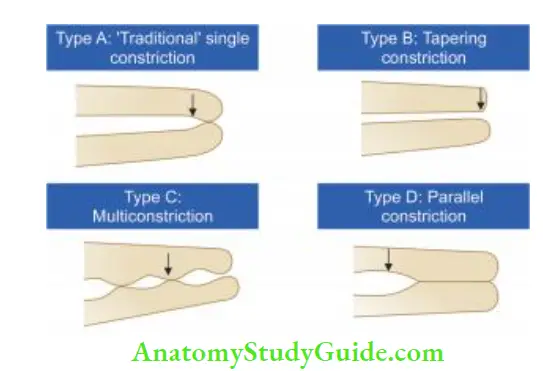 Working Length Determination Dummer classifiation of apical constriction.