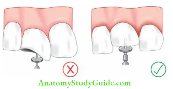 Working Length Determination Reference point should not be made of fractured tooth surface or carious tooth structure. These should be first removed for avoiding loss in working length