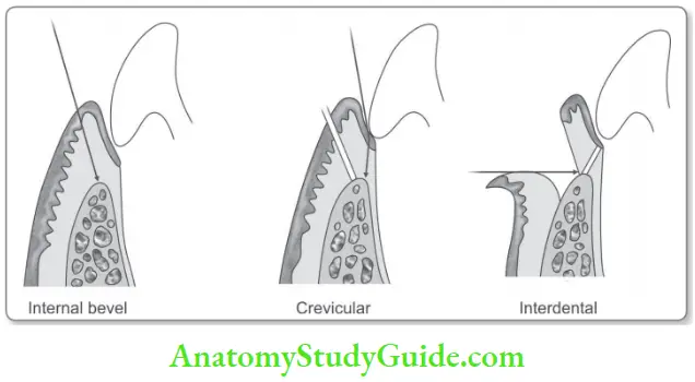 Access Flap Surgery Incisions