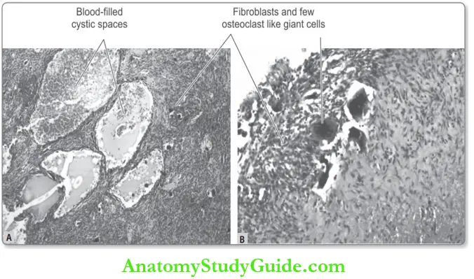 Bone Aneurysmal Bone Cyst