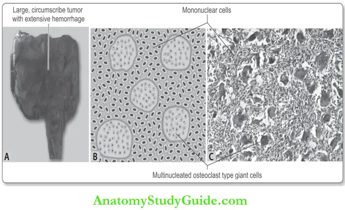 Bone Giant-cell Tumor Of Bone