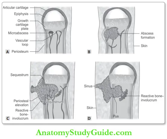 Bone Pathogenesis Of Hematogenous Osteomyelitis