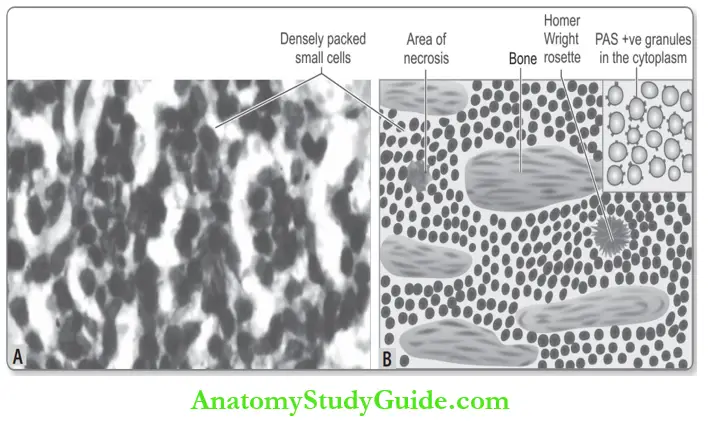 Bone Photomicrograph And Diagrammatic Ewing Sarcoma Composed Of Sheets Of Closely