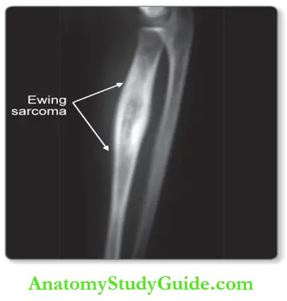 Bone X-ray Of Ewing Sarcoma