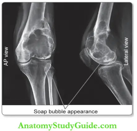 Bone X-ray Of The Knee Join