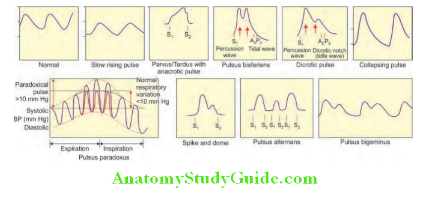 Cardiology Diagrammatic appearances of various arterial waveforms
