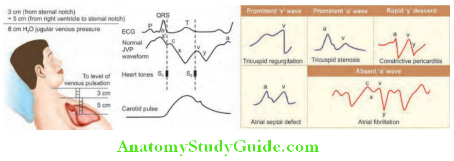 Cardiology Wave patterns in jugular venous pressure (JVP) and Abnormalities of JVP