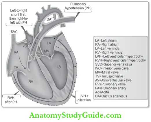 Pathology Cardiovascular System Congenital Heart Disease Notes ...