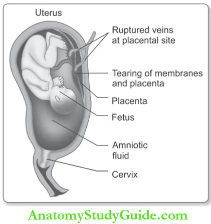 Hemodynamic Disorders Amniotic Fluid Embolism