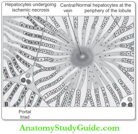 Hemodynamic Disorders Chronic Venous Congestion Liver Shows Centrilobular Necrosis With Degenerating Hepatocytes.