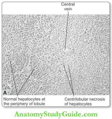 Hemodynamic Disorders Chronic Venous Congestion Liver Shows Centrilobular Necrosis With Degenerating Hepatocytes