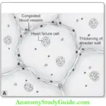 Hemodynamic Disorders Chronic Venous Congestion Lung